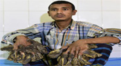Bangladesh: après 16 opérations, retour à la vie normale pour l’«homme-arbre»